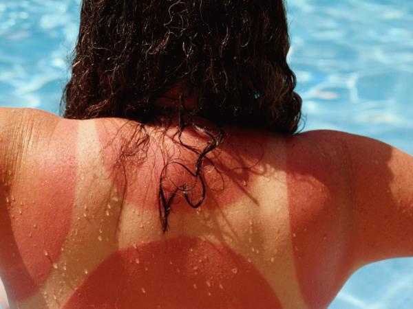 Kako zdraviti opekline, ko vas sonce preveč opeče